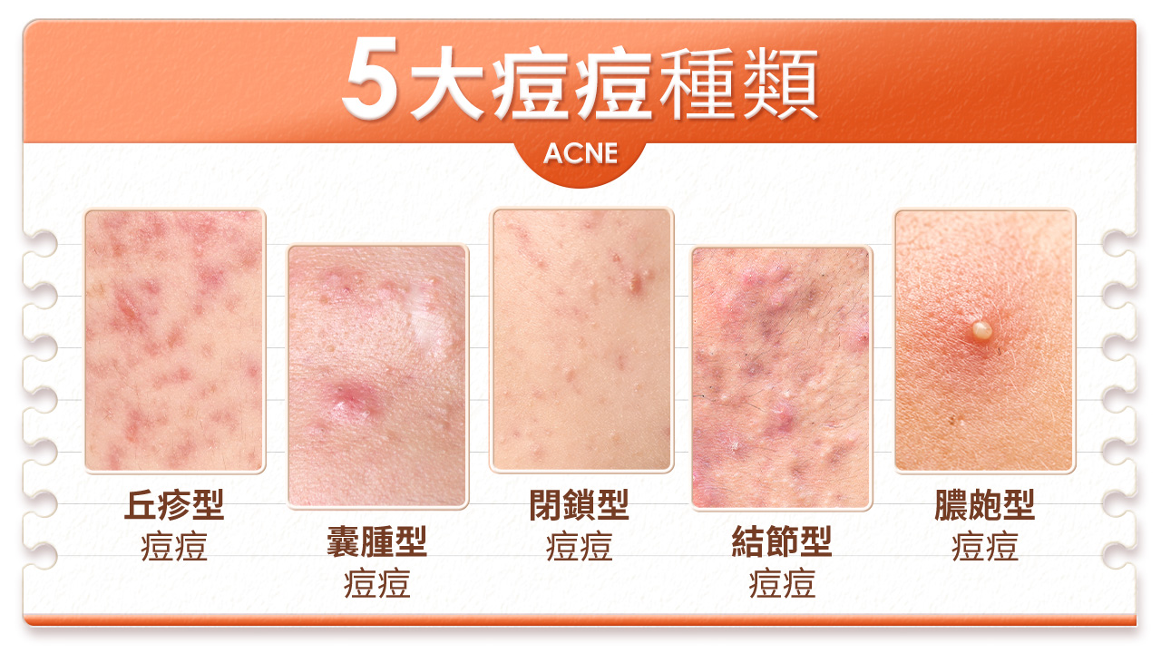 4種痘痘種類解析:丘疹型、膿包型和結節型痘痘特徵與處理方式 | JS婕洛妮絲