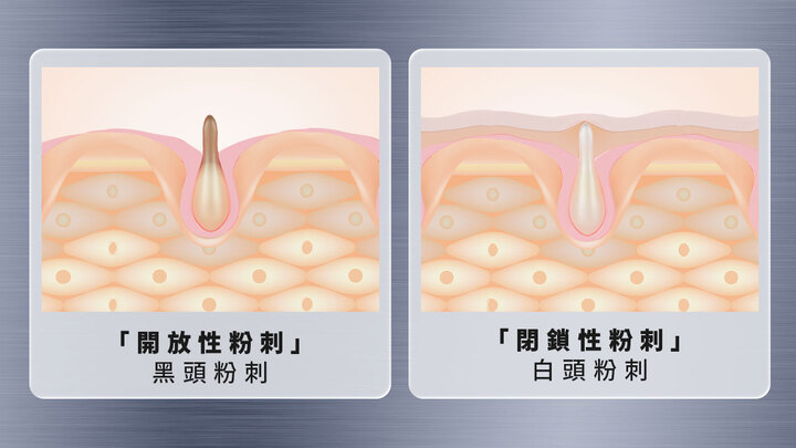 粉刺是什麼?一招代謝粉刺最有感的方式! | Dr. May 美博士官方網站