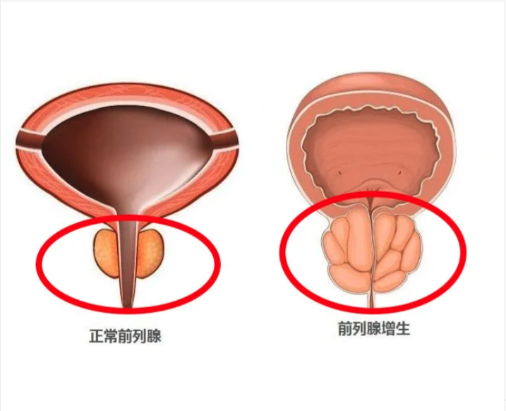 改善攝護腺肥大01